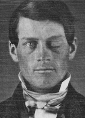 Phineas Gage Survives Iron Rod Through Skull
